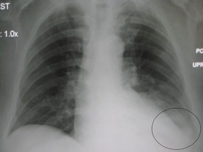 Chest auscultation x-ray family nurse practitioner practice questions