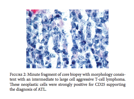 Core Biopsy with T-cell lymphoma