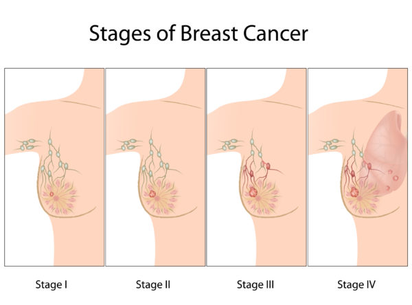 Stages of Breast Cancer