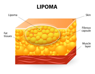 lipoma