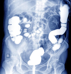 x-ray of barium enema